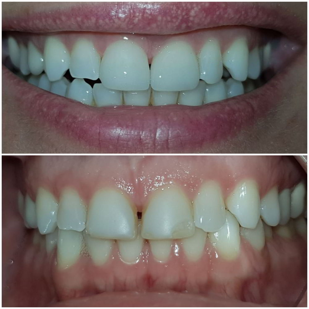 Fatete dentare din ceramica presata E-max pe incisivii centrali superiori