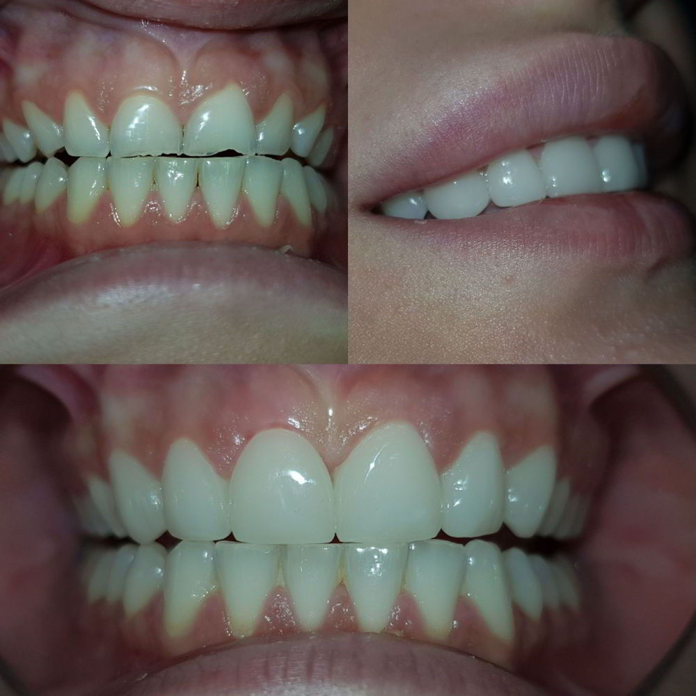 Fatete dentare din ceramica presata E-max pe dintii frontali superiori