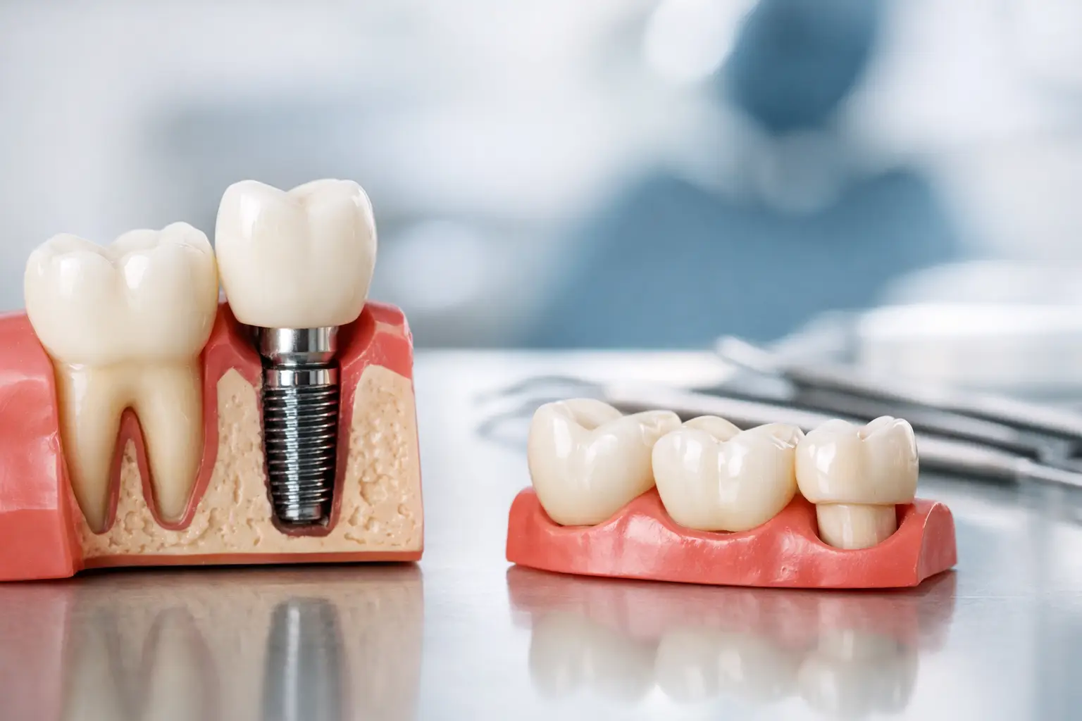 Implant sau punte dentară - cum alegi corect