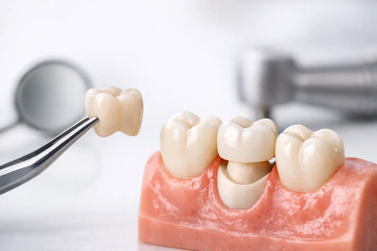 Când ai nevoie de coroană dentară și de ce