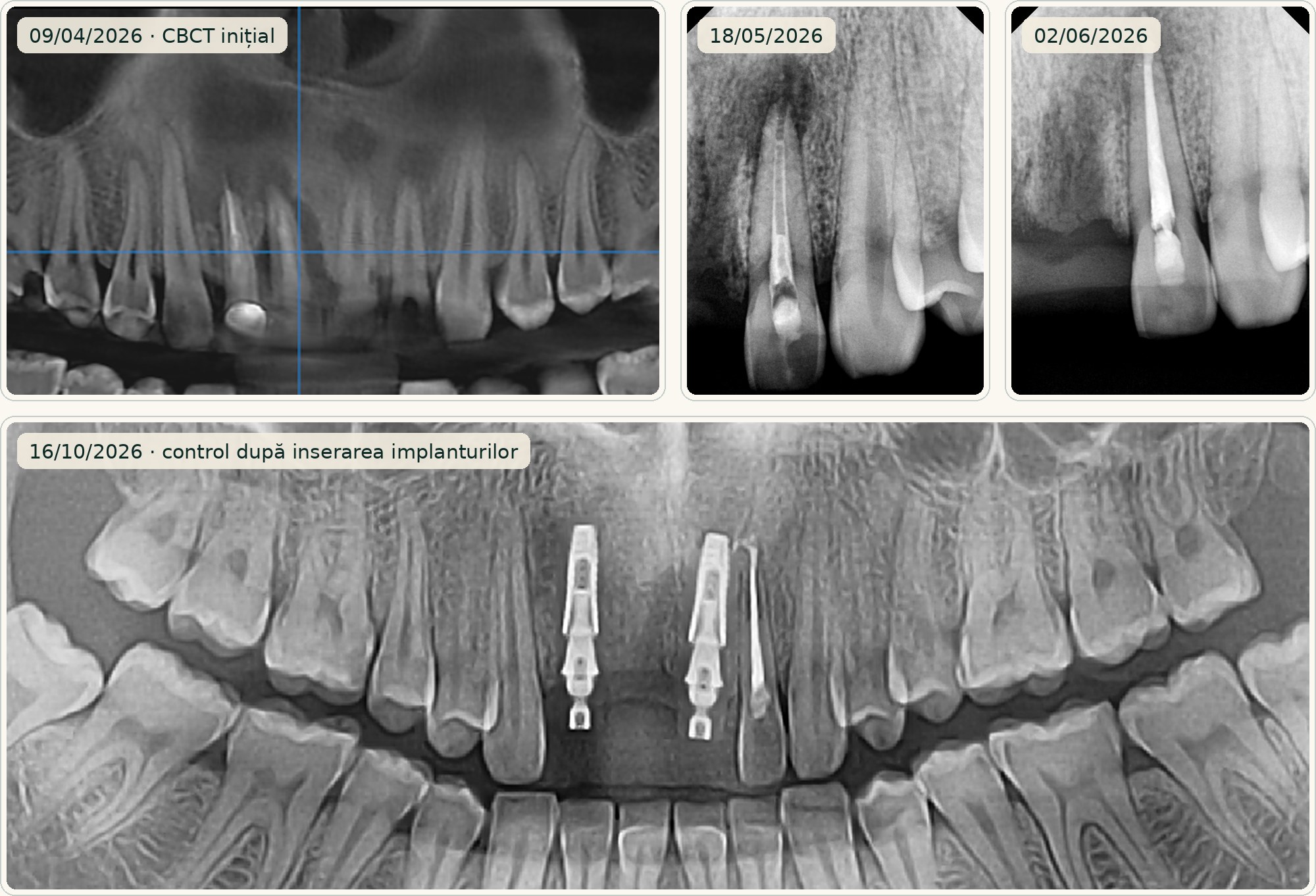 Evoluție radiologică, incisiv lateral superior stâng: CBCT inițial, radiografii retroalveolare și radiografie panoramică de control după inserarea implantului