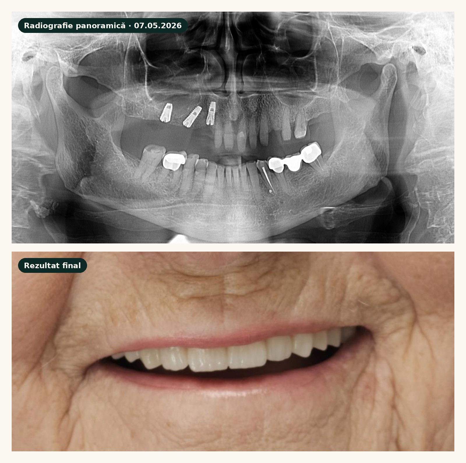 Radiografie panoramică după inserarea a 3 implanturi în maxilar și aspectul final al zâmbetului după restaurarea protetică