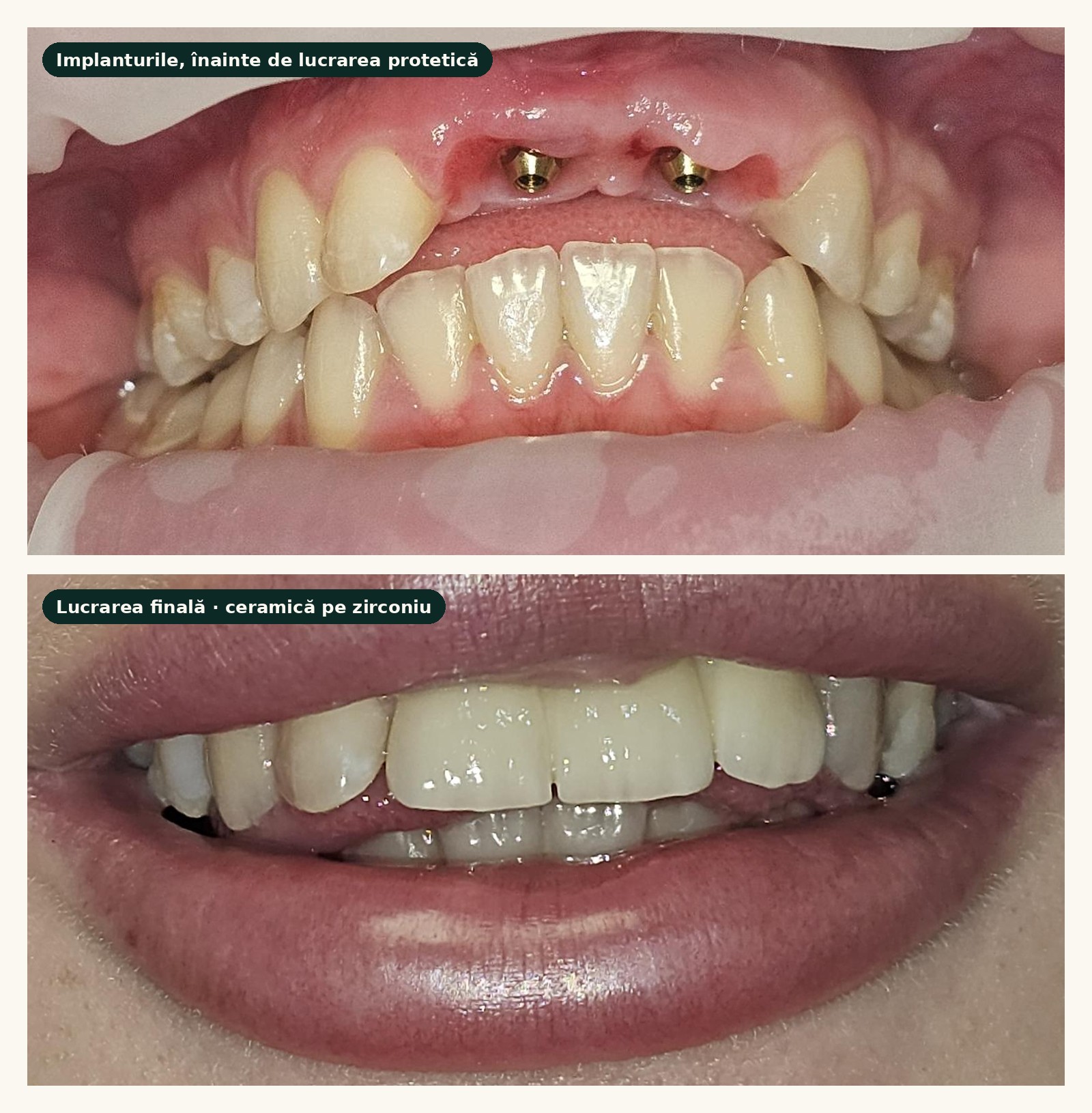 Două implanturi dentare în zona frontală a maxilarului înainte de lucrarea protetică și zâmbetul după cimentarea lucrării din ceramică pe zirconiu