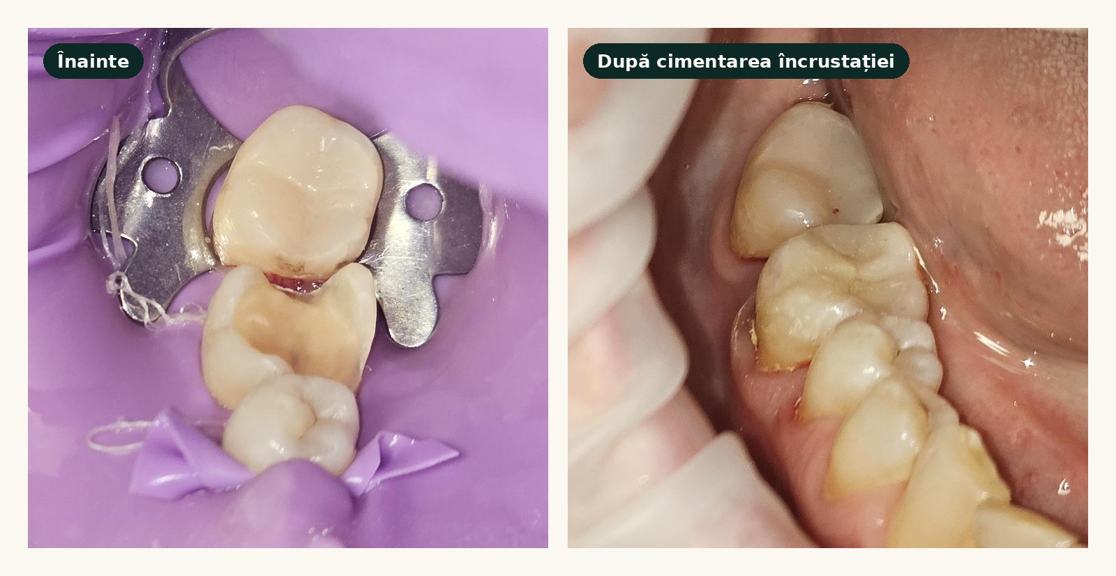 Dinte posterior afectat de carie, izolat cu diga, și același dinte după cimentarea unei încrustații din ceramică presată