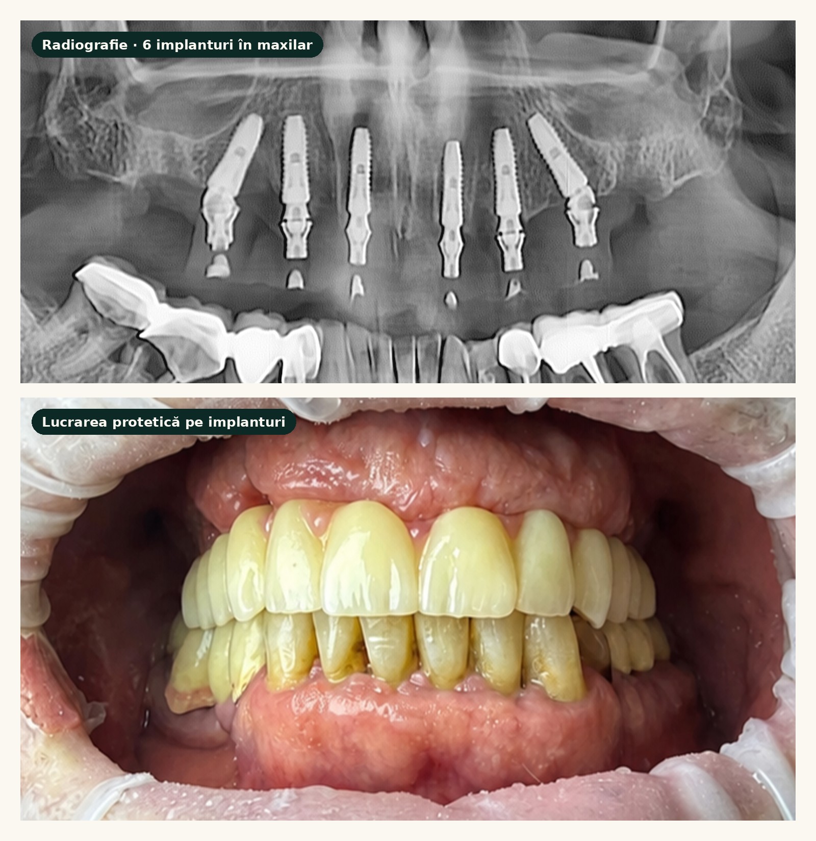 Radiografie cu 6 implanturi dentare în maxilar și aspectul clinic al lucrării protetice pe implanturi